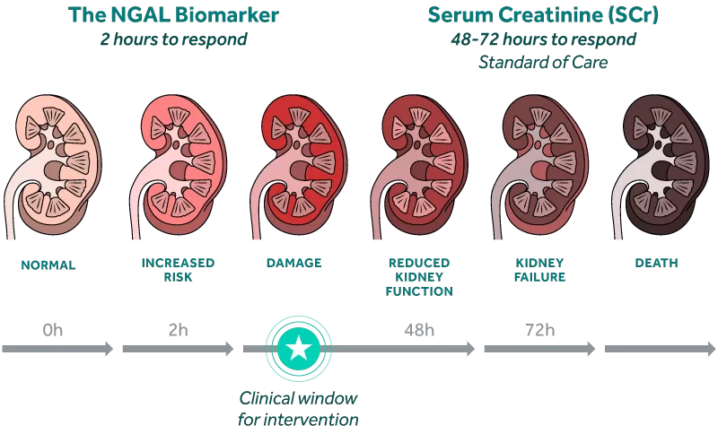 Diagram comparing NGAL Biomarker (2-hour response) and Serum Creatinine (48-72 hour response) in detecting kidney issues, highlighting a 2-48 hour intervention window.